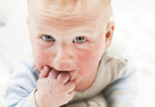 Podstawy leczenia atopowego zapalenia skóry Dzieck z AZS