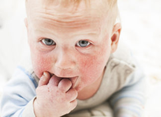 Podstawy leczenia atopowego zapalenia skóry Dzieck z AZS