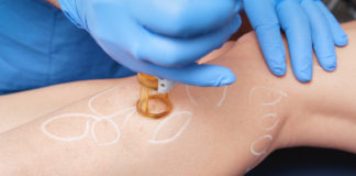 Masz objawy żylaków kończyn dolnych – nie zwlekaj z leczeniem Leczenie żylaków