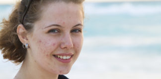 Trądzik dorosłych – skąd się bierze i jak z nim walczyć? Trądzik u dorosłej kobiety