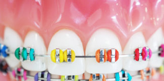 Czym jest ortodoncja i jak przebiega leczenie ortodontyczne? Ortodoncja - aparat na zębach