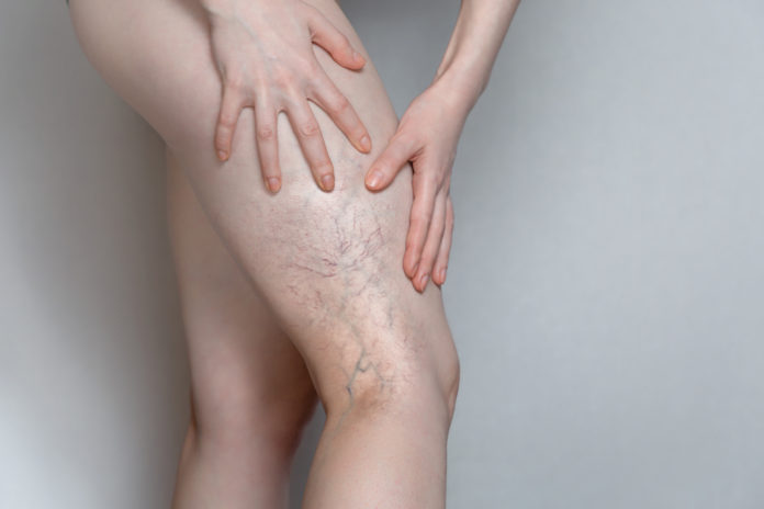 zbliżenie na kobiecą nogę żylaki przewlekłą niewydolność żylna