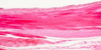 Zespół Marfana – czym się objawia, co powoduje i jak się go leczy? tkanka łączna