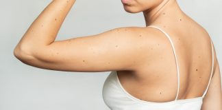 Laserowe usuwanie pieprzyków Kraków laserowe usuwanie pieprzyków kraków