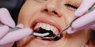 Najpopularniejsze rodzaje koron zębowych korony porcelanowe na zębach pacjenta