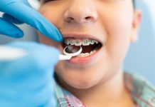 Kiedy najlepiej rozpocząć leczenie ortodontyczne u dzieci? leczenie ortodontyczne u dzieci