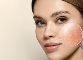 Skóra nadwrażliwa – jak odpowiednio ją pielęgnować? skóra nadwrażliwa